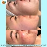 AdvaTX treatment for acne