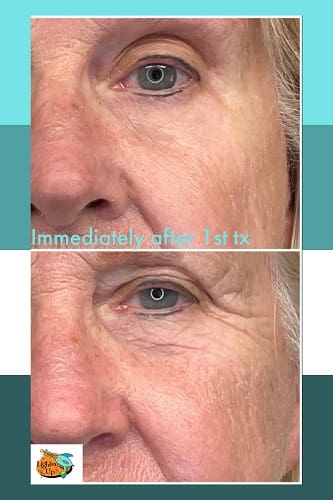 Fine line and wrinkle reduction